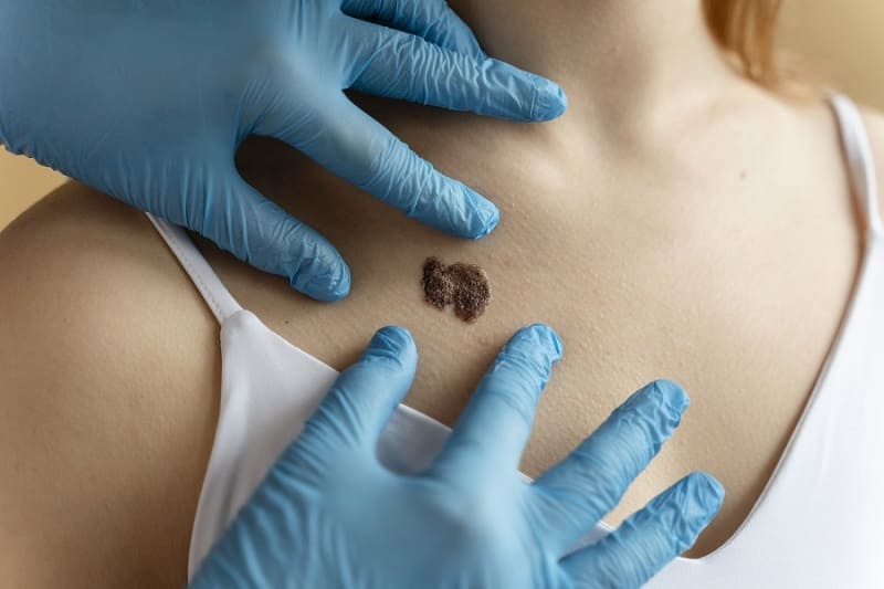 Eliminación de verrugas por VPH