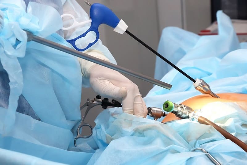 Prostatectomía radical por laparoscopia